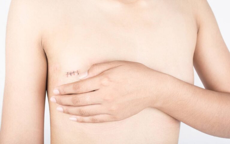 Vivir-tras-un-cancer-de-mama-la-verdadera-larga-enfermedad