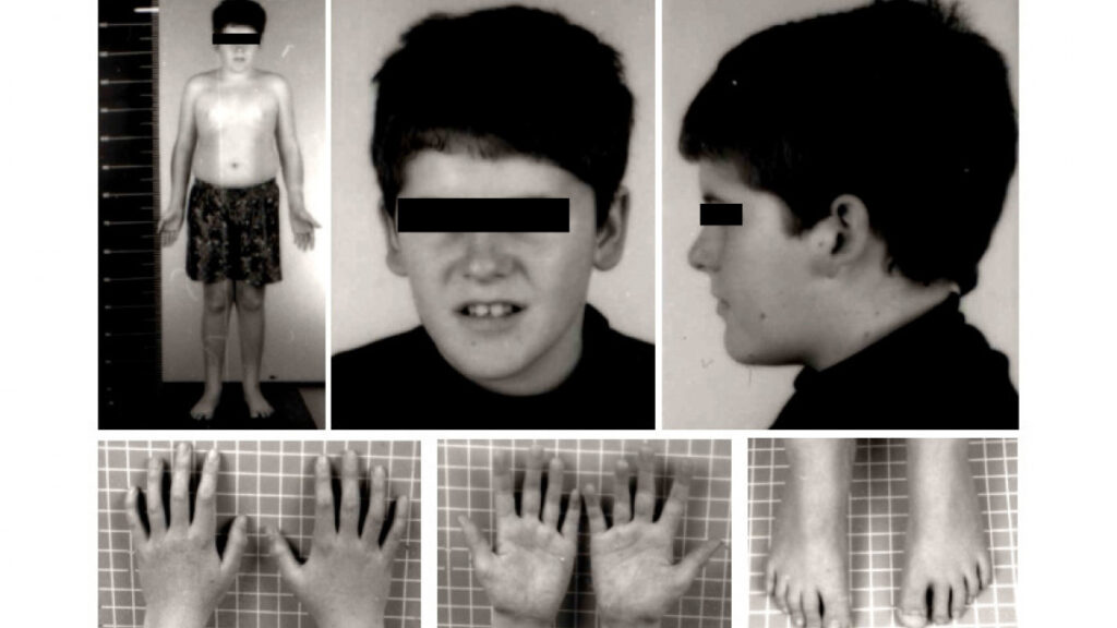 sindrome-prader-willi-wide