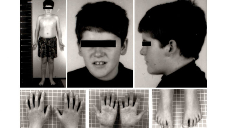 sindrome-prader-willi-wide