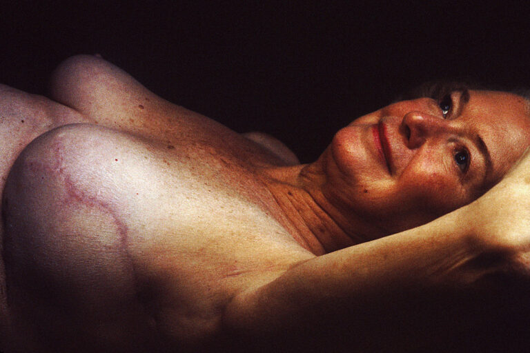 1200px-Breast_reconstruction_2