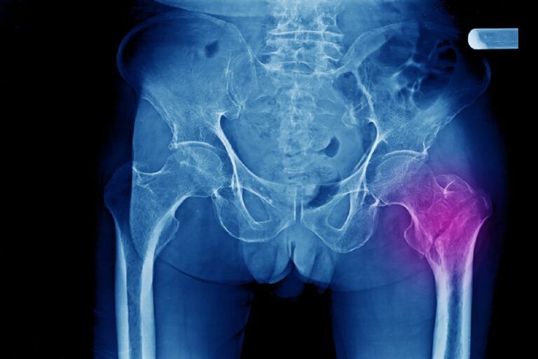 A,Pelvic,X-ray,Of,An,Elderly,Patient,Showing,Osteoporotic,Intertrochanteric