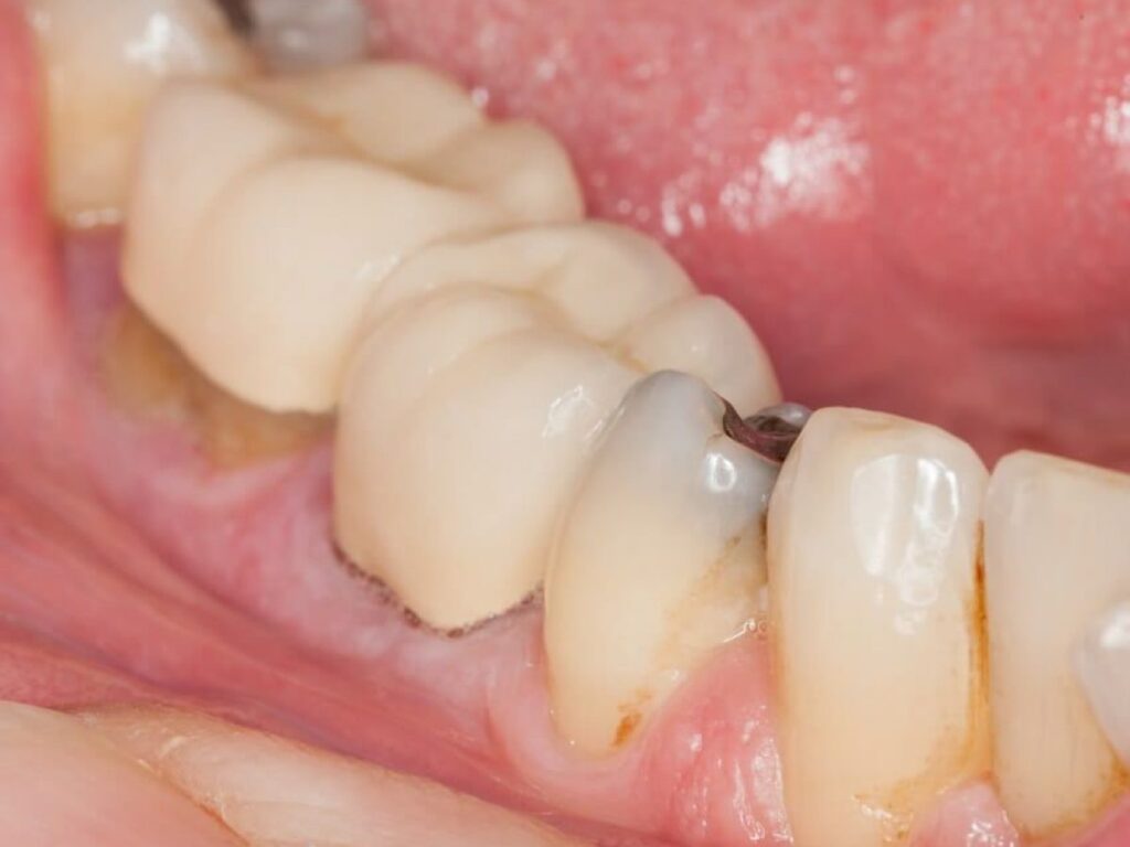 como-saber-si-tienes-caries-1200x900