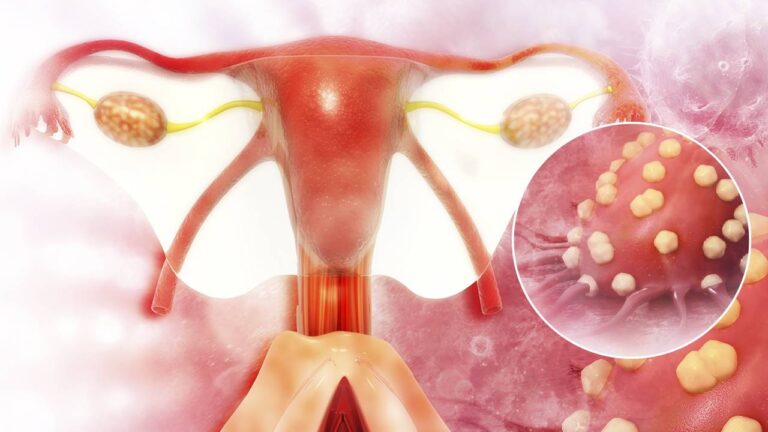 cancer-de-ovario