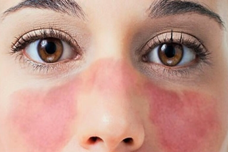 lupus