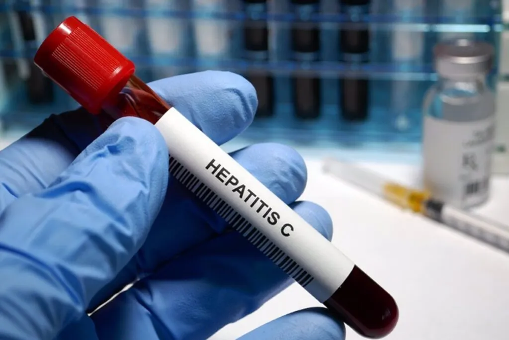 Breve guía sobre la hepatitis c: la importancia del diagnóstico precoz