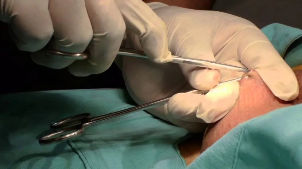 Crece 66.6% la demanda de vasectomías