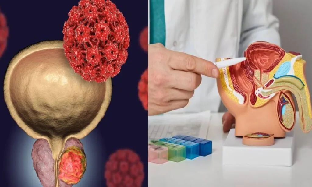 cancer de prostata