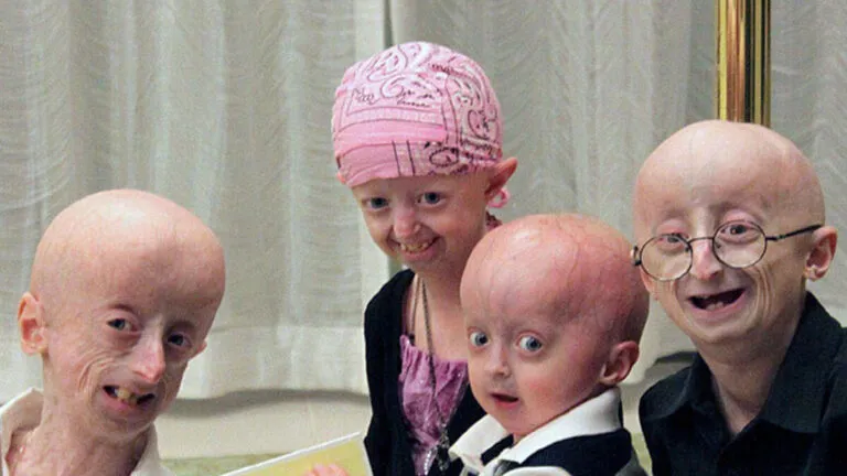progeria