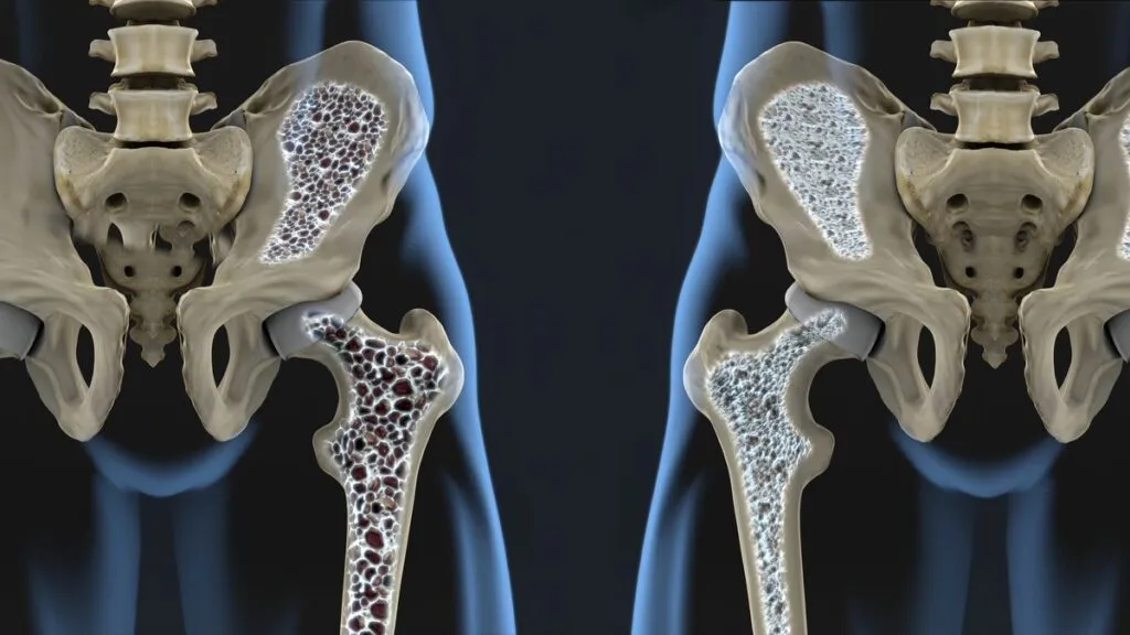 osteoporosis-enfermedad