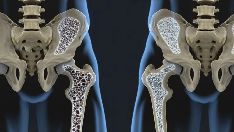 osteoporosis-enfermedad