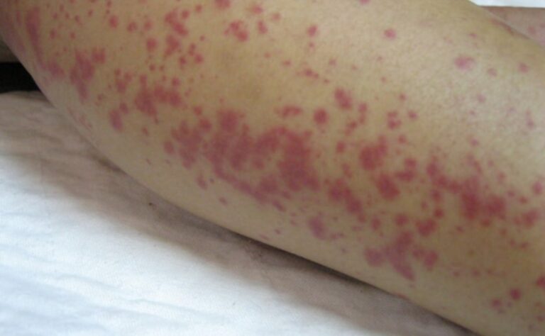 leptospirosis