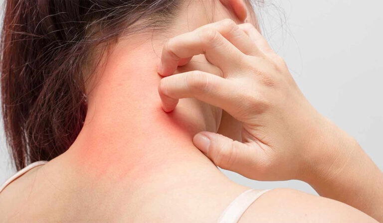alergia