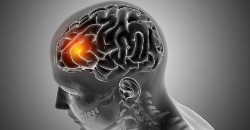 3D male medical figure with front of the brain highlighted