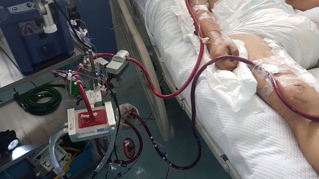 ecmo
