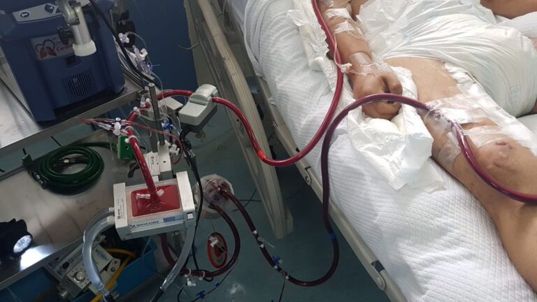 ecmo