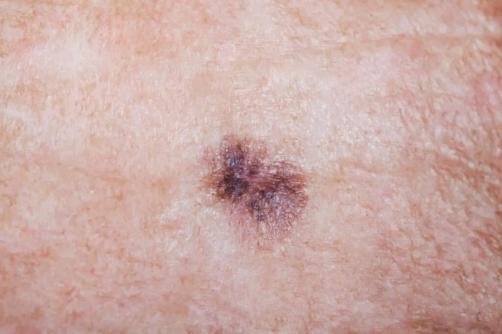 Melanoma