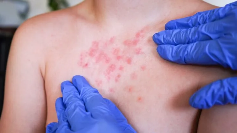 brotes-de-sarampion-activos-en-mexico-sintomas-contagio-y-como-protegerte-104924