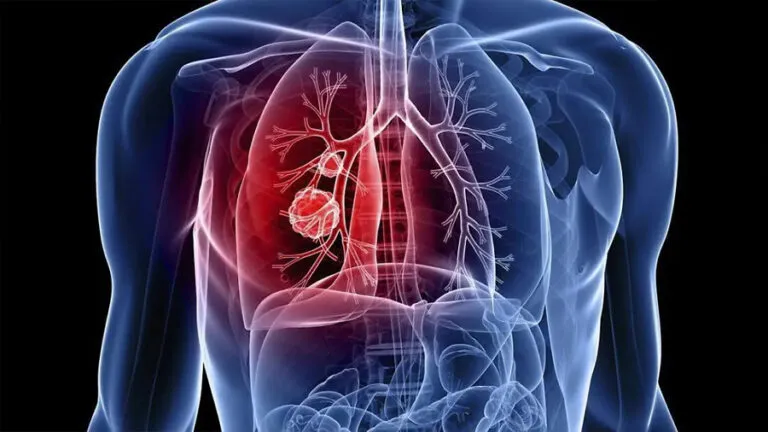 pulmonar