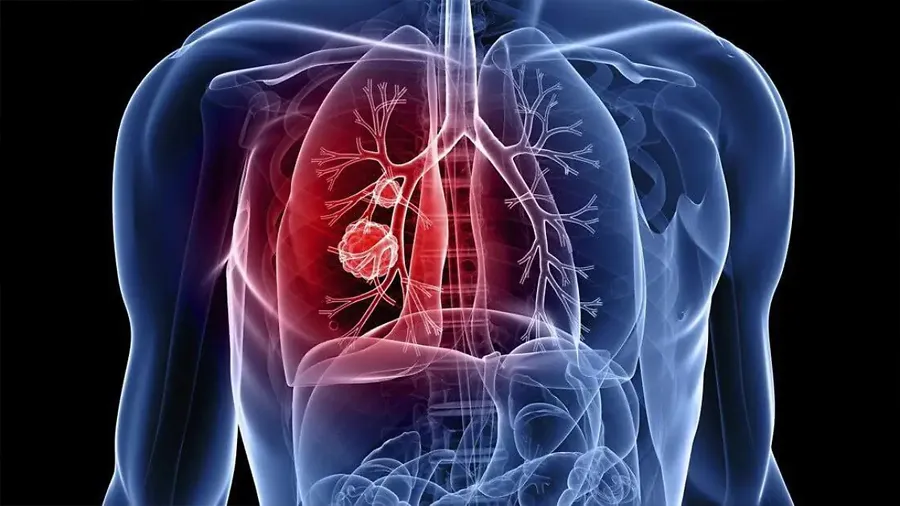 pulmonar