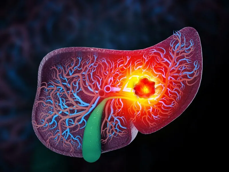 tumor-hepatico